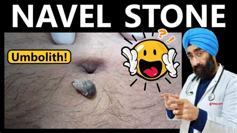 navel stone symptoms|Belly Button Stones Can Be Found Exactly Where Youd Expect